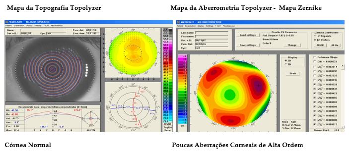 Aberrometria Ocular (C)