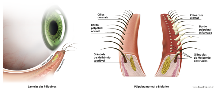 Blefarite, hordéolo e calázio. São a mesma coisa?