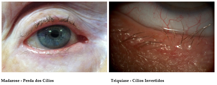 Blefarite: quais são as causas, consequências e tratamento? – Instituto de  olhos de Florianópolis