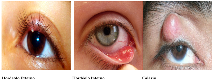 Qual a diferença entre Hordéolo e Calázio?