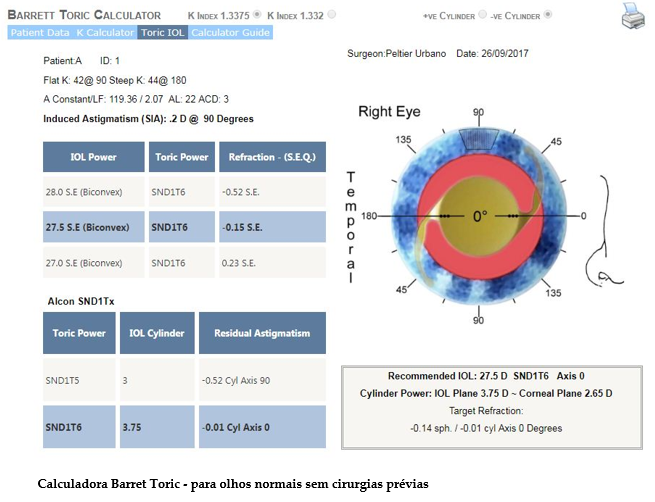 Cálculo da Lente Intraocular (Ct)