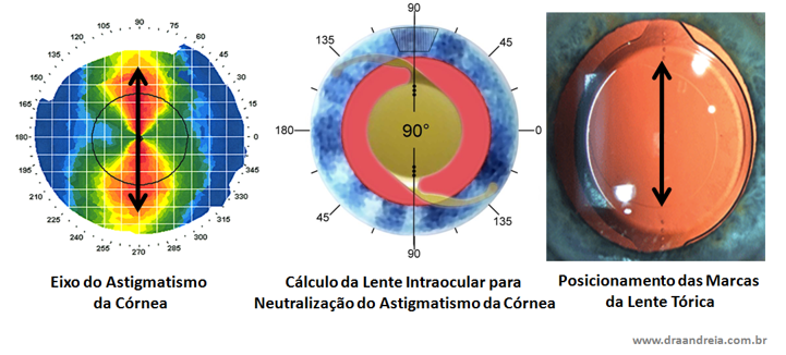 Lentes Intraoculares Trifocais: indicações, vantagens e recomendações