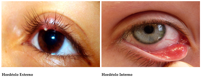 Clínica de olhos Levate - 👀 Terçol ou Hordéolo: 1. O que é? Pequeno nódulo  infeccioso na região palpebral, mais precisamente na base dos cílios.  Geralmente ocorre por uma obstrução das glândulas