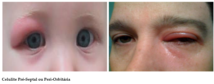 Clínica de olhos Levate - 👀 Terçol ou Hordéolo: 1. O que é? Pequeno nódulo  infeccioso na região palpebral, mais precisamente na base dos cílios.  Geralmente ocorre por uma obstrução das glândulas