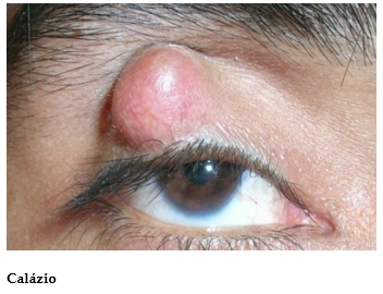 Calázio e terçol (hordéolo) - Distúrbios oftalmológicos - Manual MSD Versão  Saúde para a Família