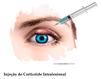 Calázio e hordéolo (terçol) - Distúrbios oftalmológicos - Manuais MSD  edição para profissionais