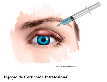 Calázio e hordéolo: o que é e como tratar