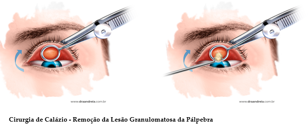 Hordéolo e Calázio - O terçol ou hordéolo é provocado pela inflamação